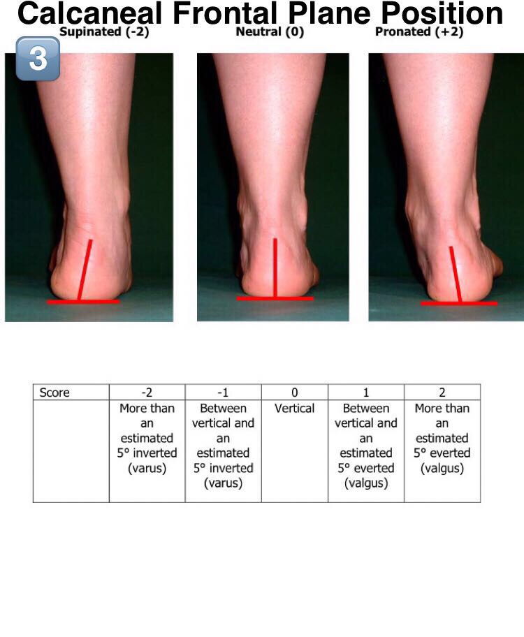 Foot Posture Index — SnapSPT 👻