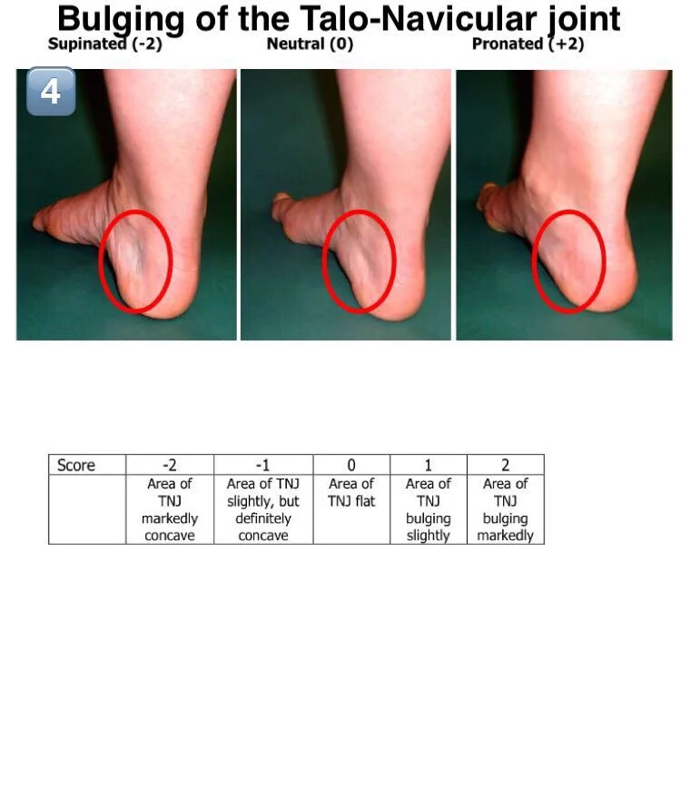 Foot Posture Index — SnapSPT 👻