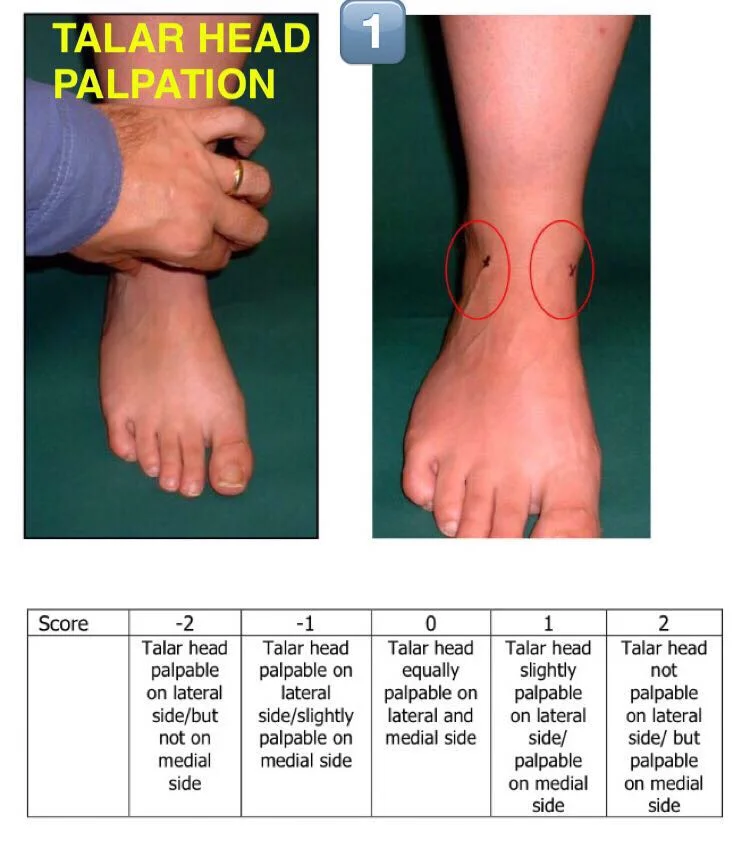 Foot Posture Index — SnapSPT 👻