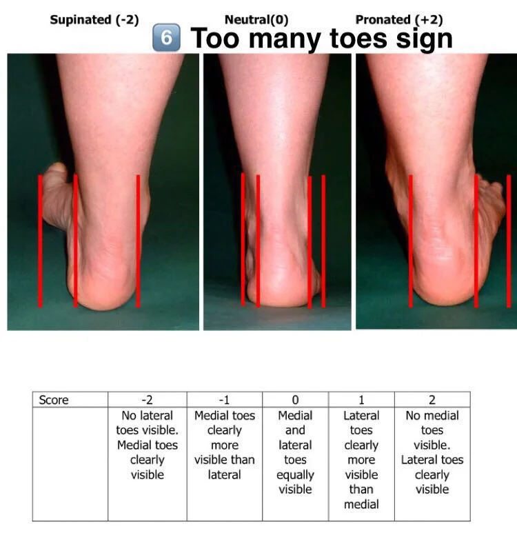 Foot Posture Index — SnapSPT 👻