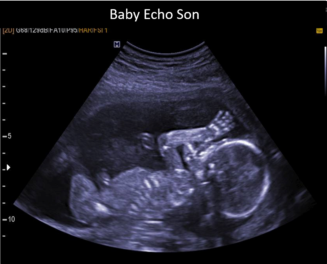 Echo 02.png