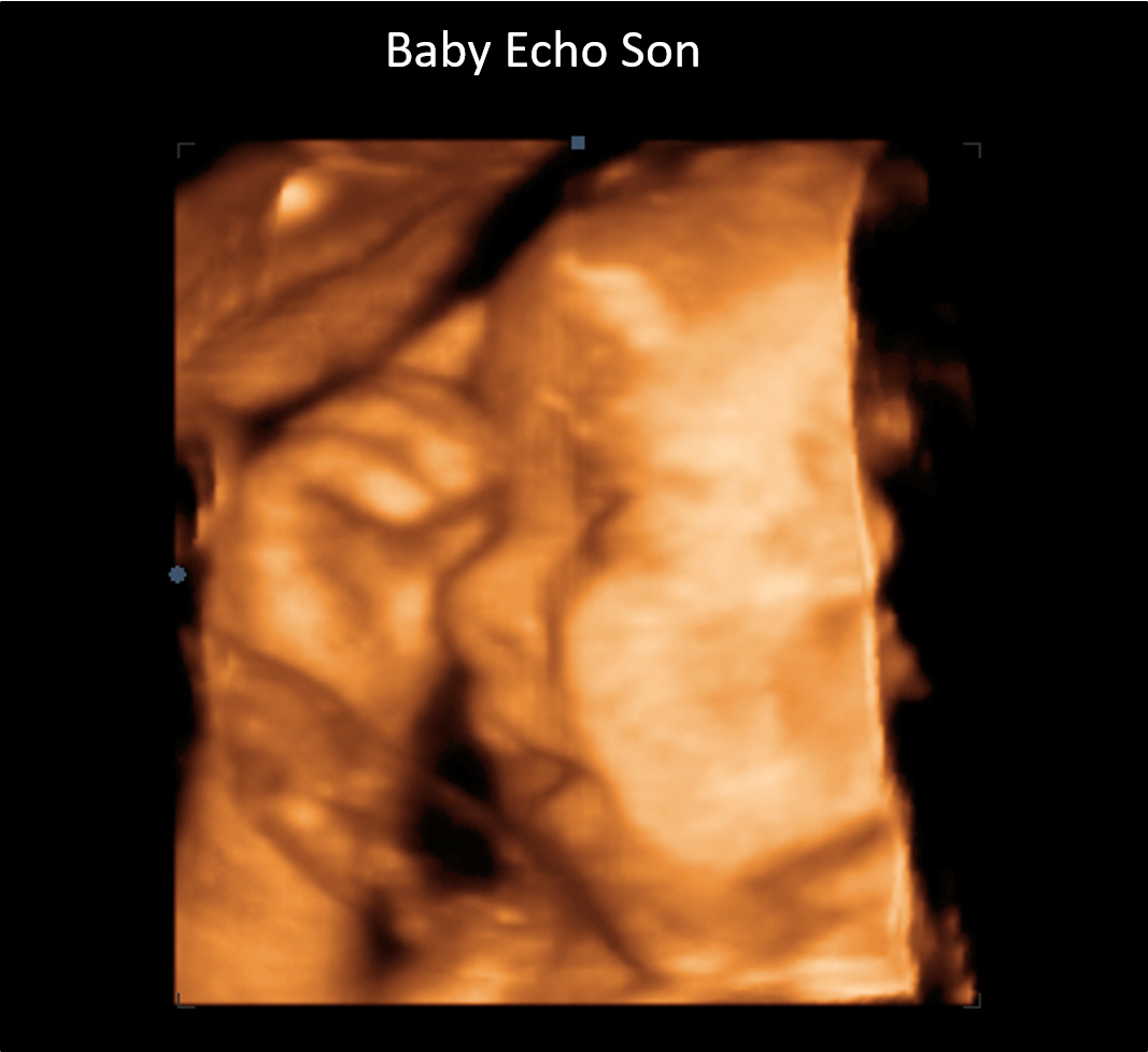 Echo 14.png