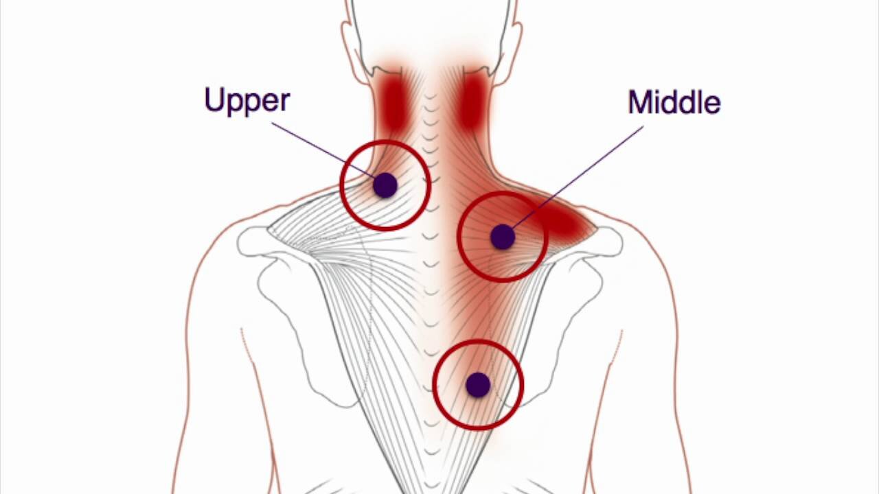 Trapezius muscle pain & trigger points