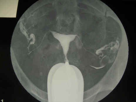 Normal HSG