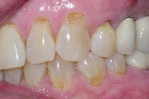 Enamel abrasion from aggressive tooth brushing.