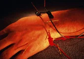 ca15787 electro-acupuncture.jpg