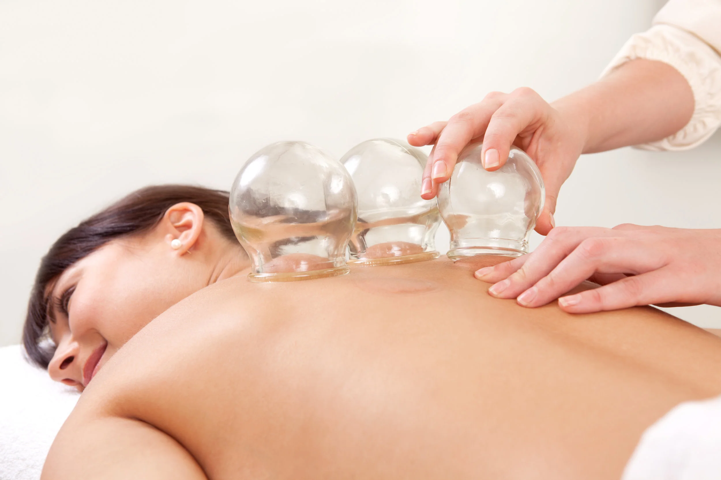 AM Acupuncture - Cupping Milford Pennsylvania.jpg