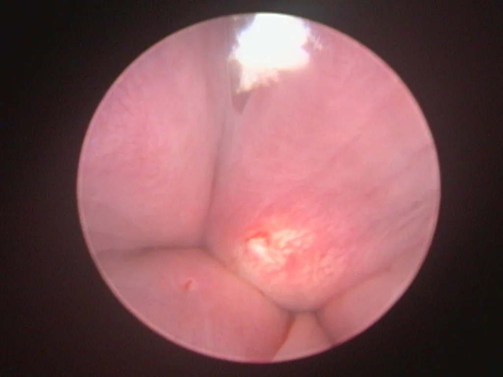 Urethral lumen now occluded by placement of 4 submucosal injections of collagen