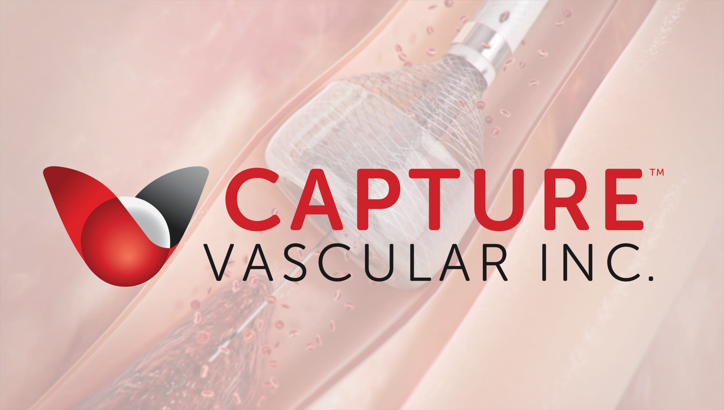 Capture's proprietary MegaVac Mechanical Thrombectomy System offers several unique features in one simple device.