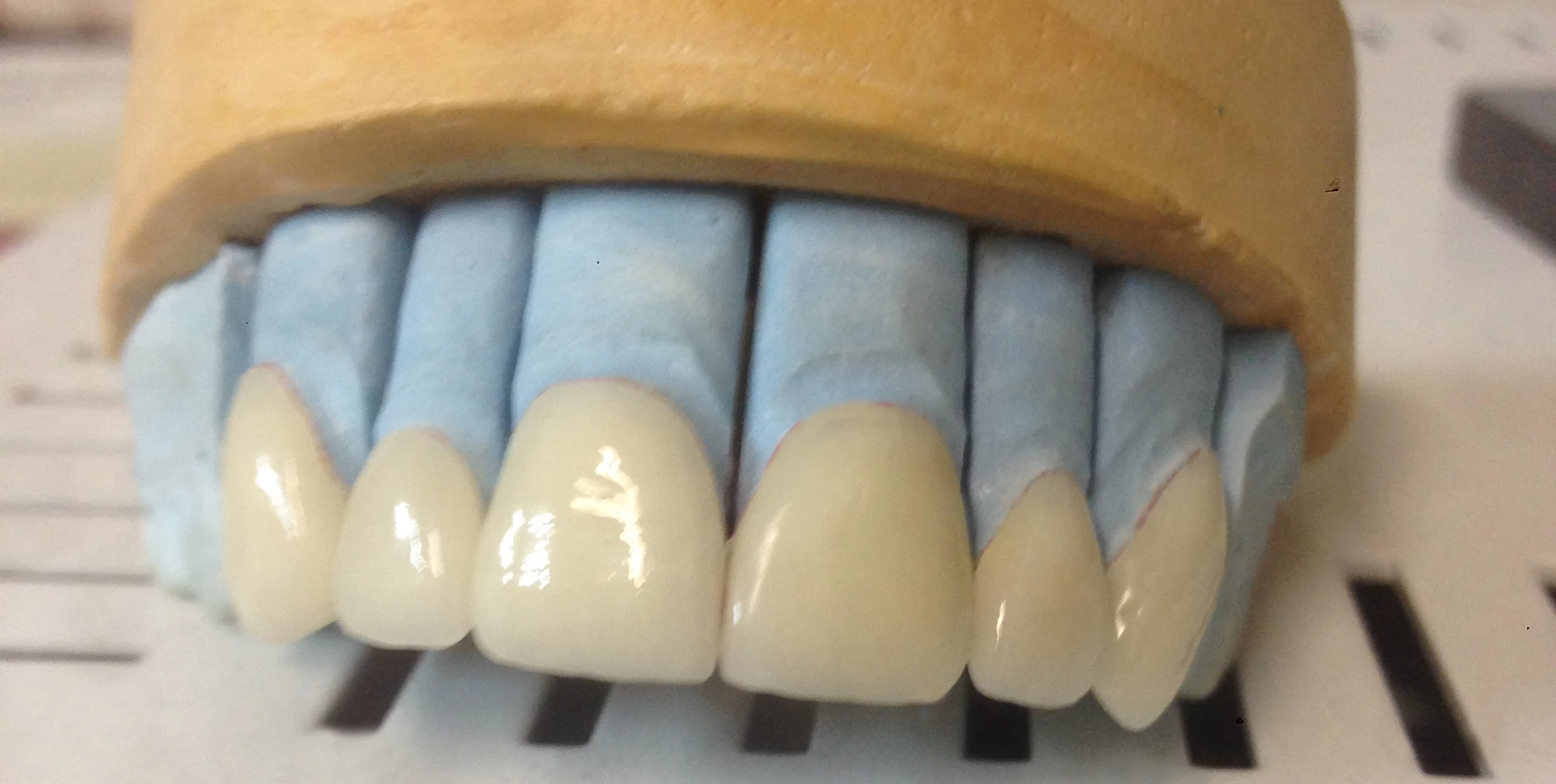 Khzam Dental Ceramics Veneer