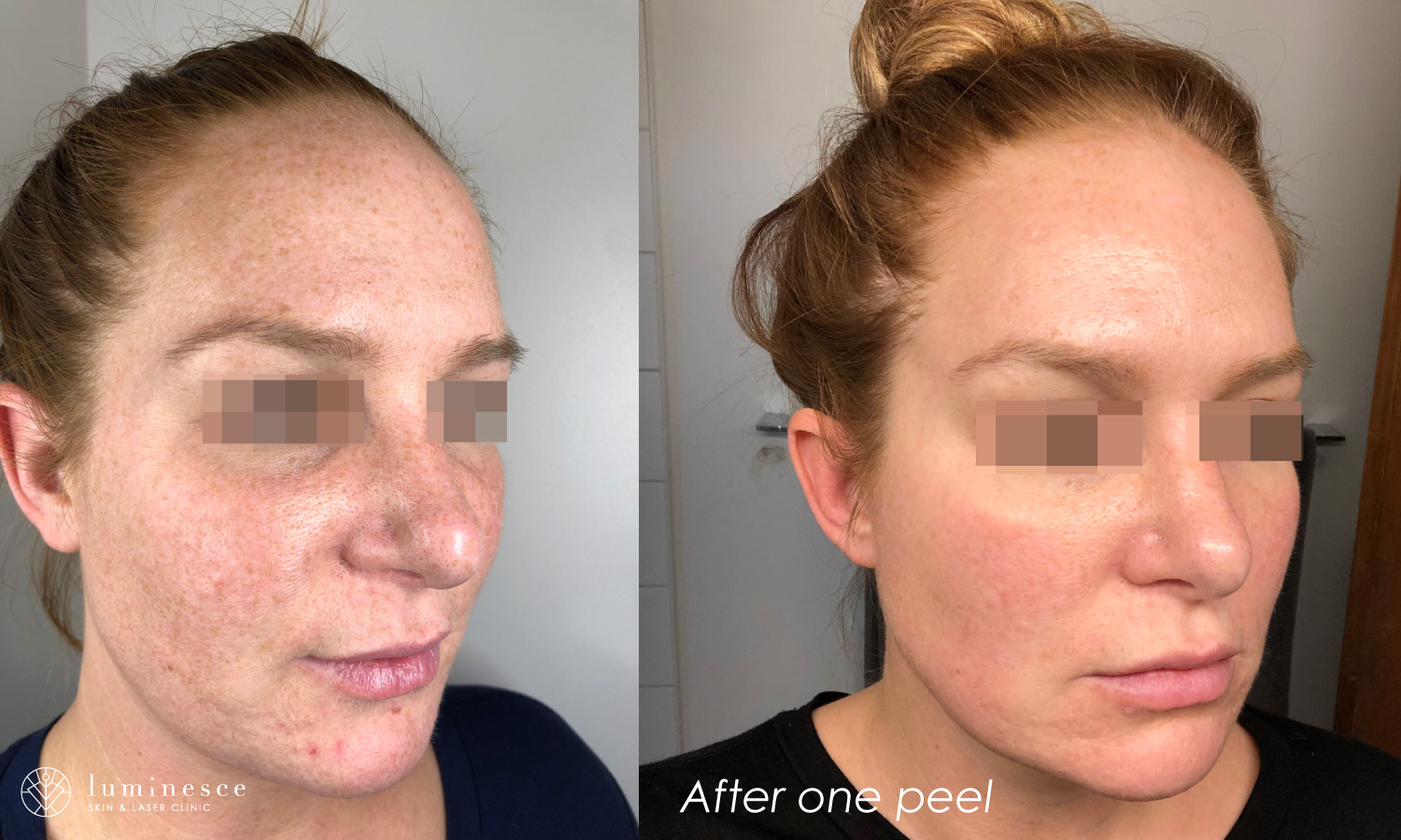 acne-1-web.png