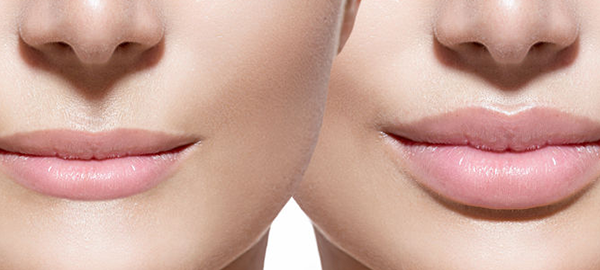 restylane-mouths.png