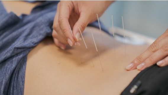 Dry Needling/Acupuncture