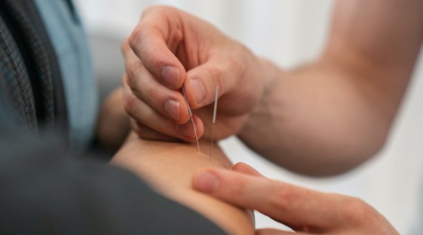 Acupuncture &amp; Dry Needling