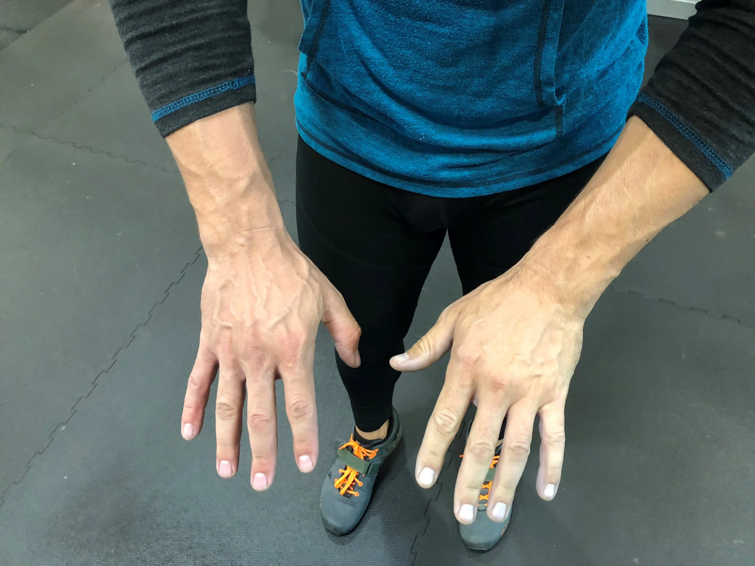 left hand was wrapped too tight which is identifiable by pale coloration, and sometimes less vascularity.