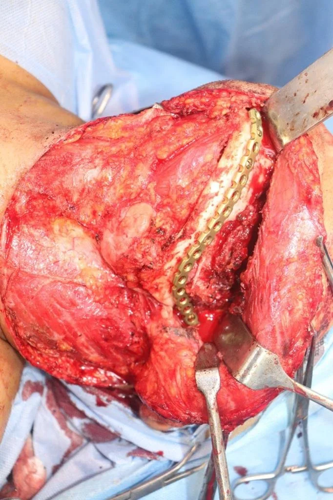 Cancer - Retromolar Trigone 