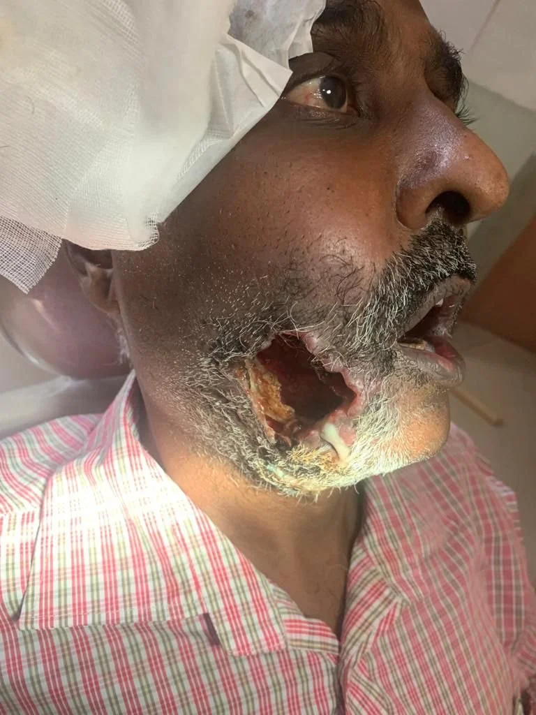 Cancer Buccal Mucosa involving the skin