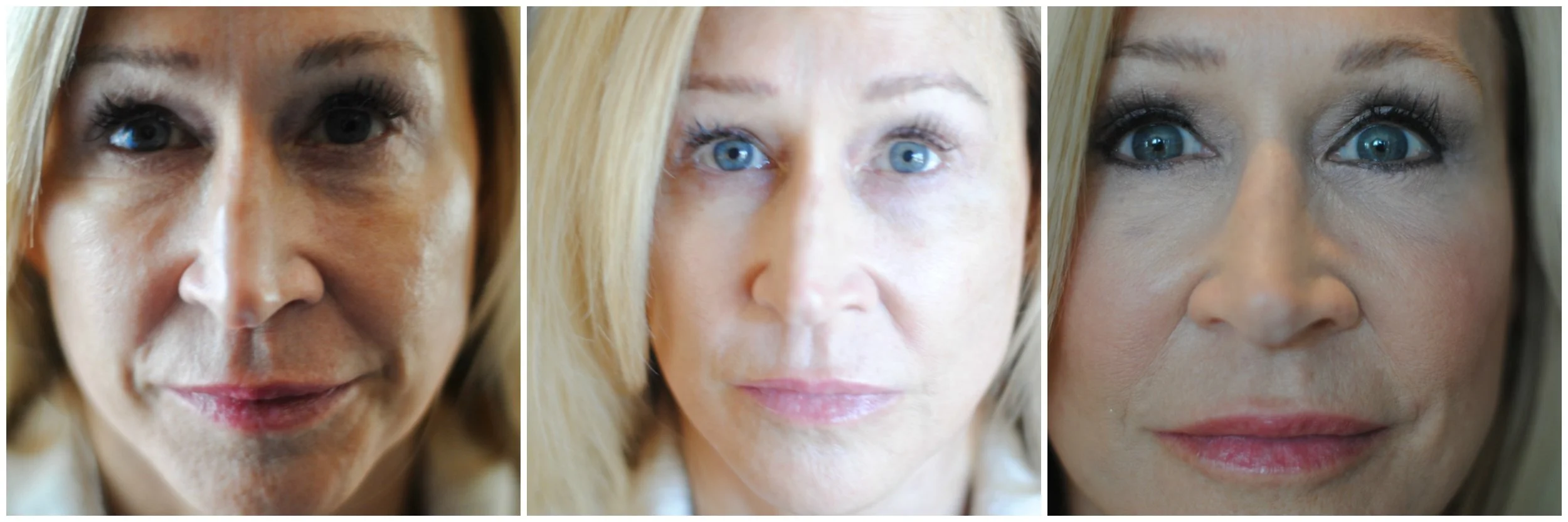 Eye Surgery