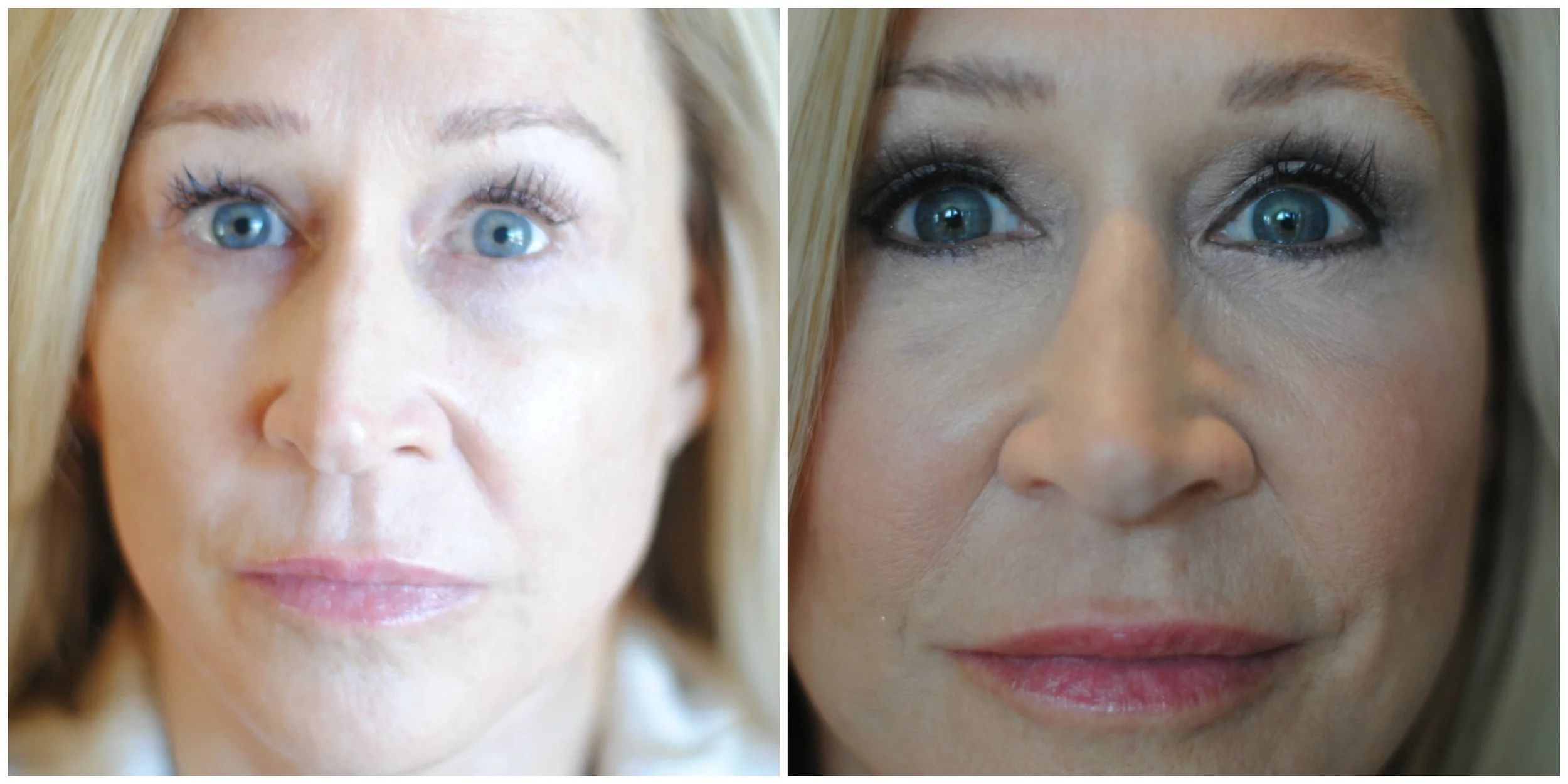 Eye Surgery