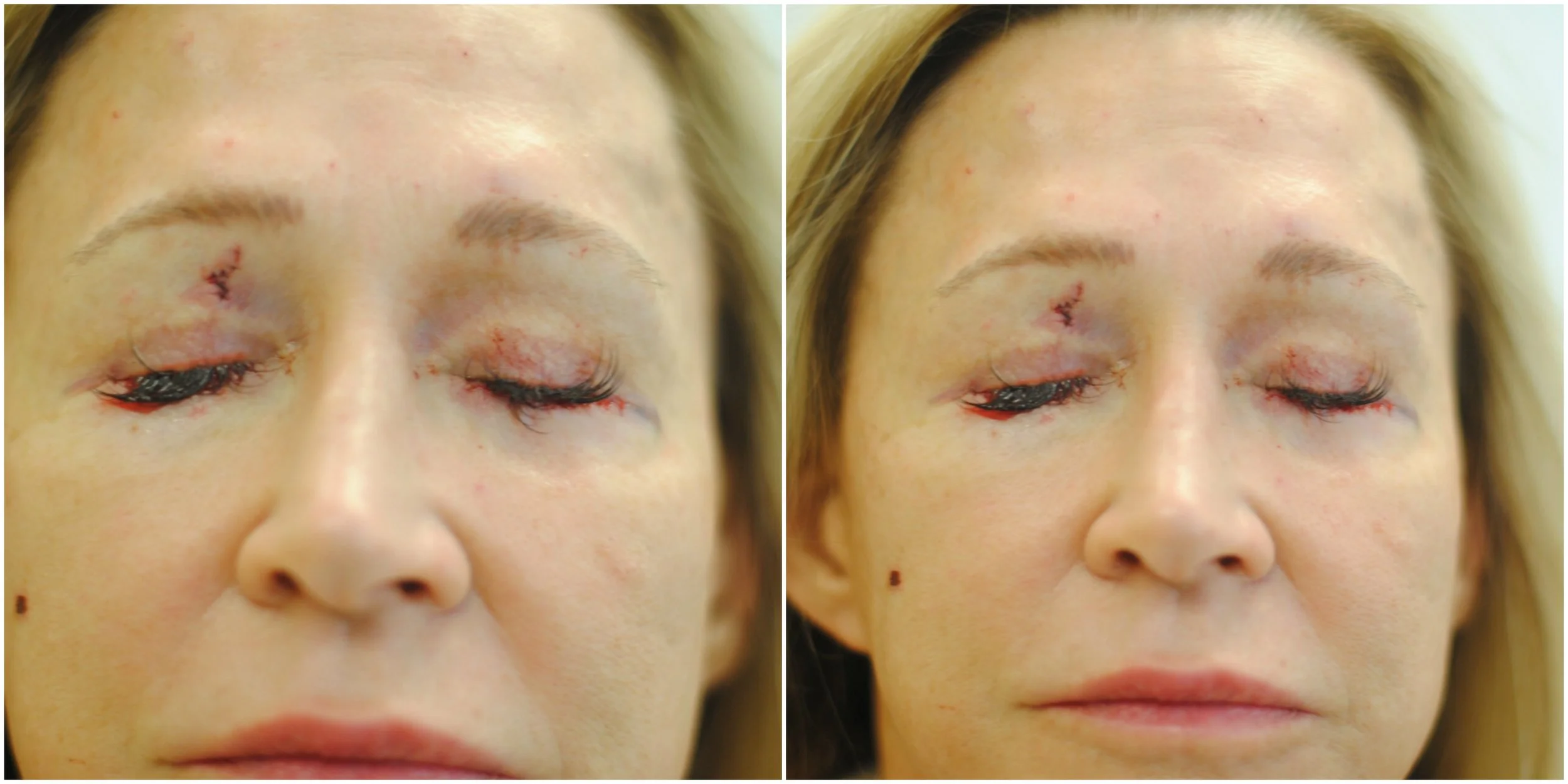 Eye Surgery