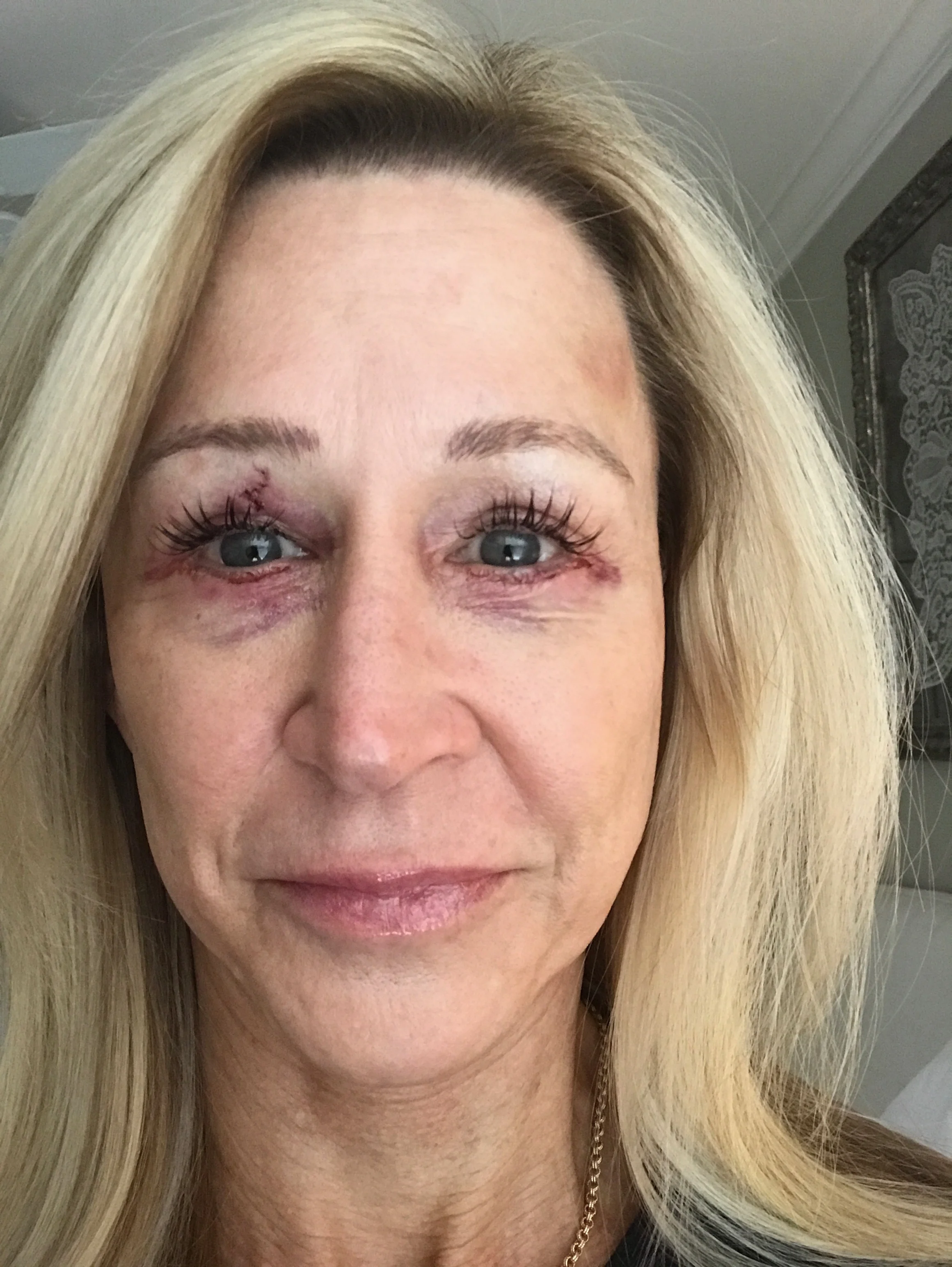 Eye Surgery