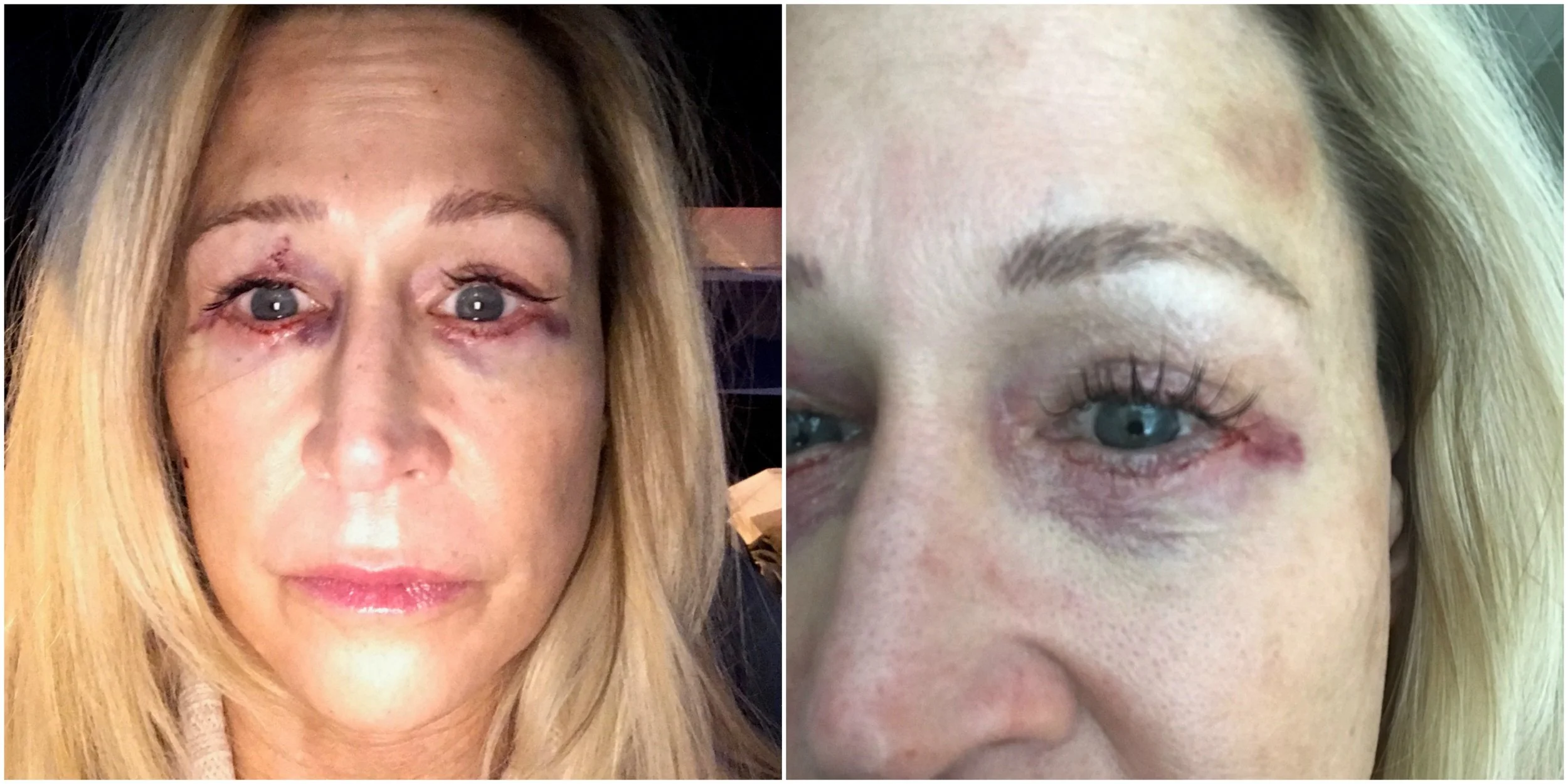 Eye Surgery