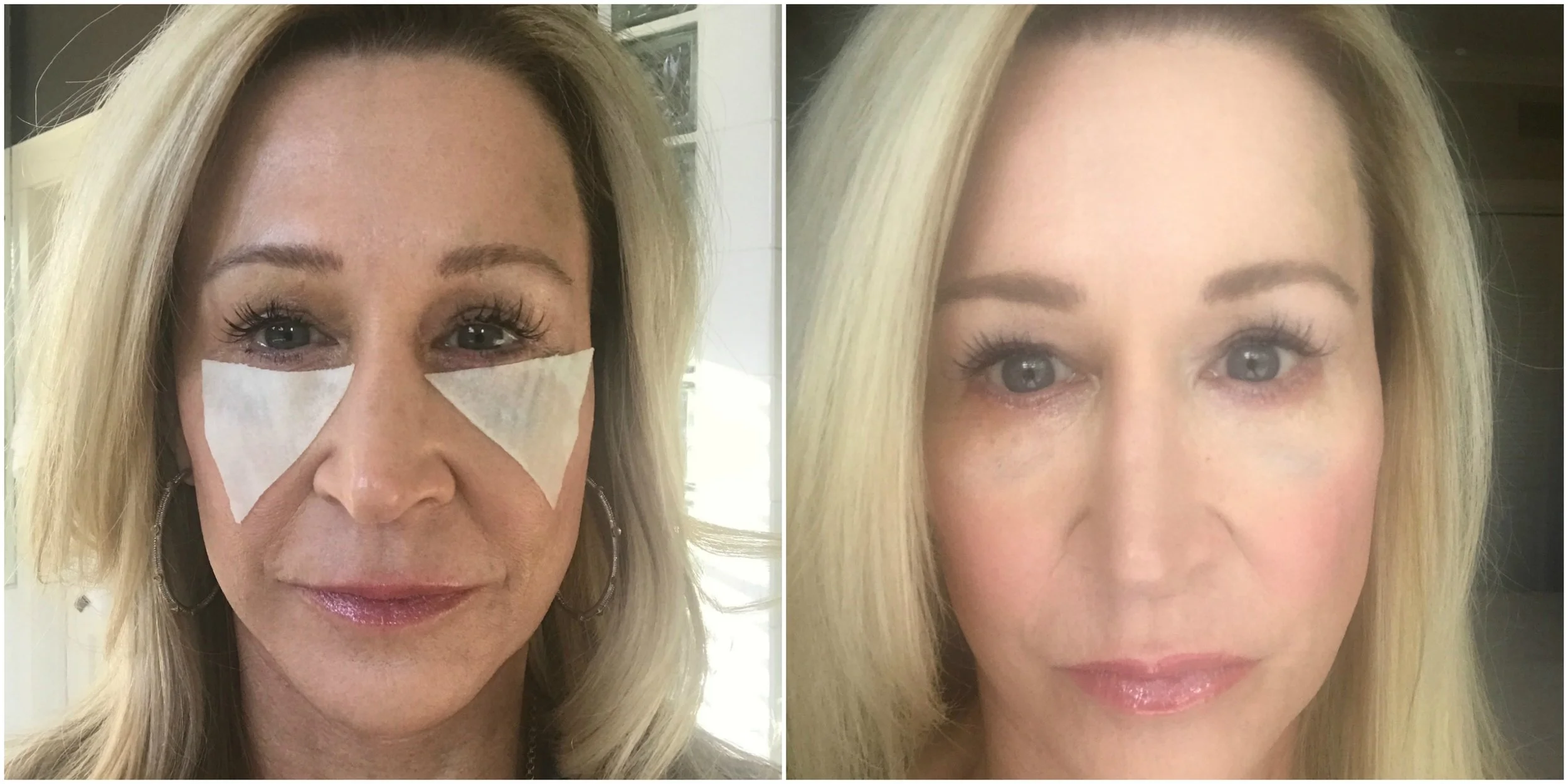 Eye Surgery