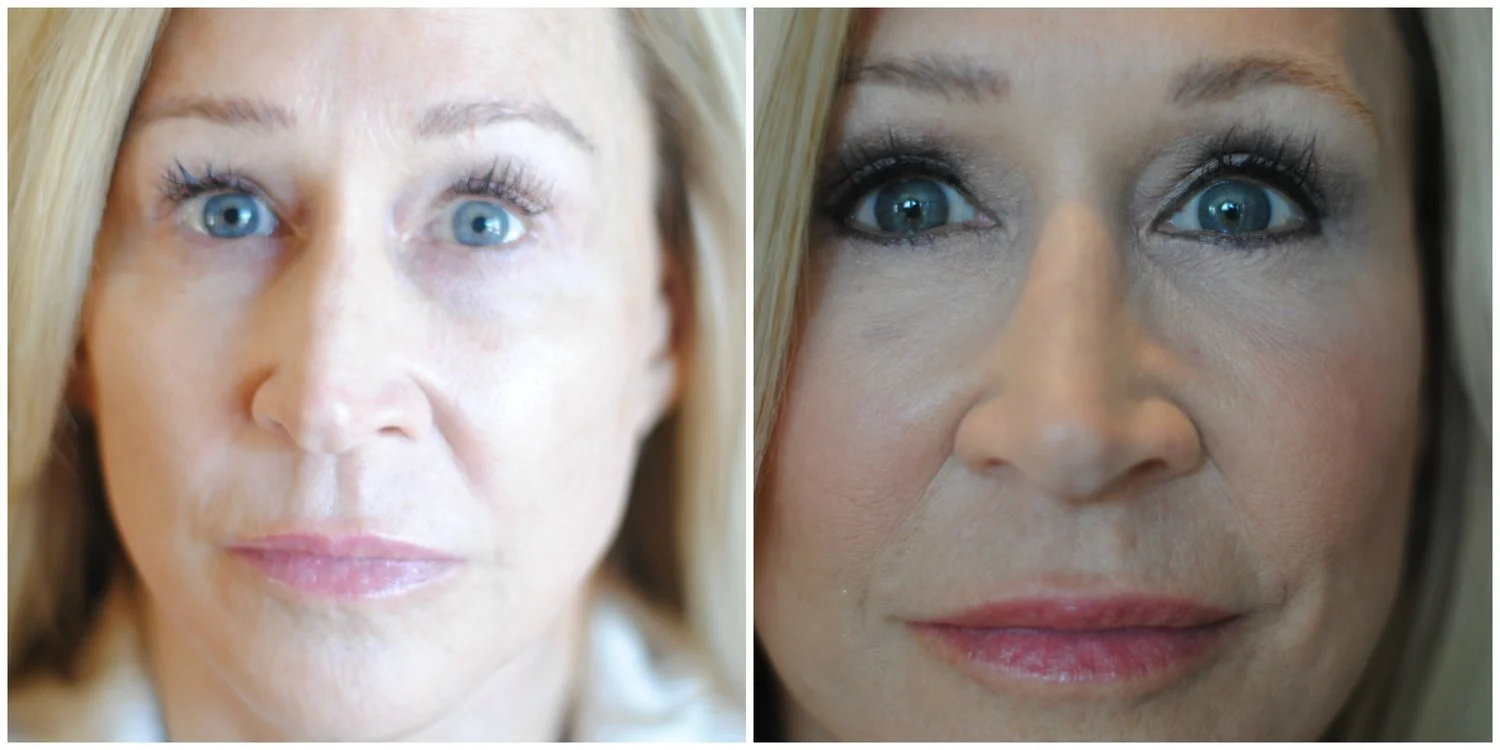 Blepharoplasty - My Eyelid Surgery