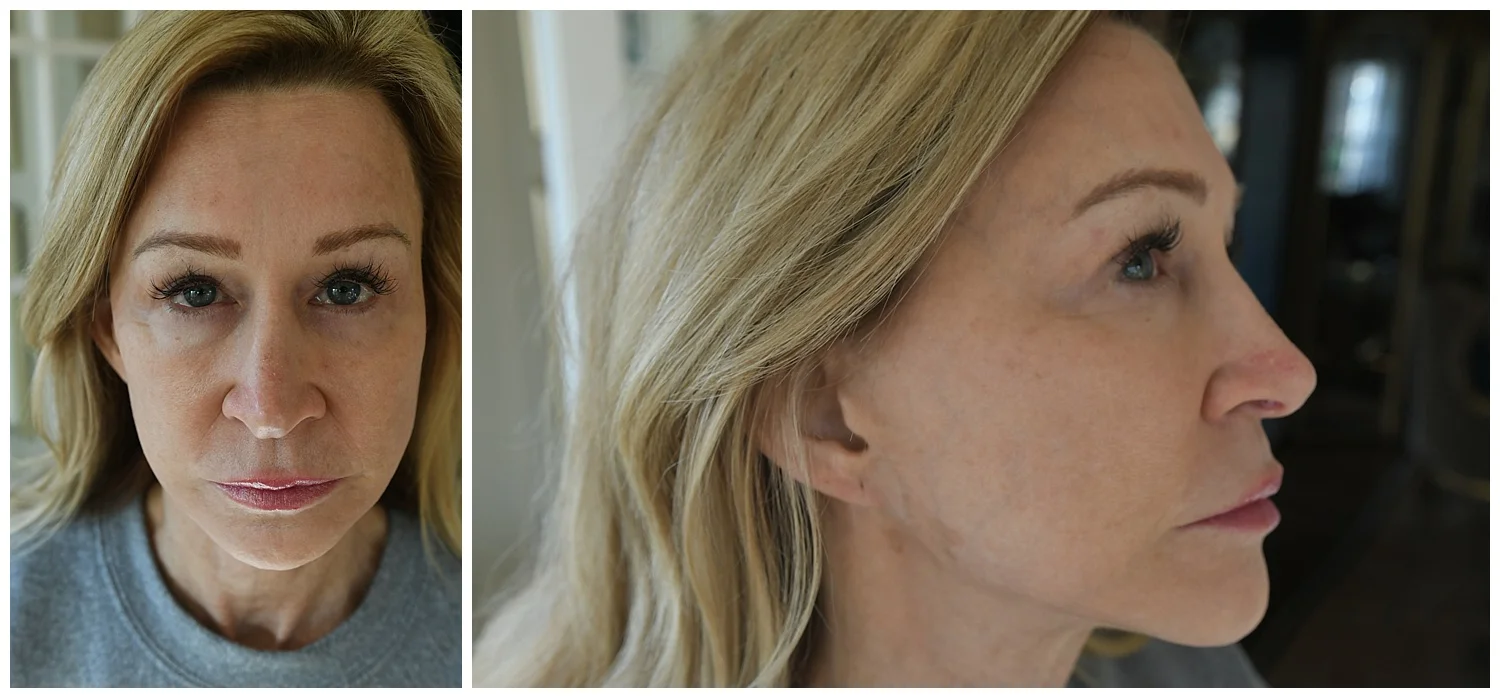 My Experience With the Halo Laser at Robinson Facial Plastic Surgery