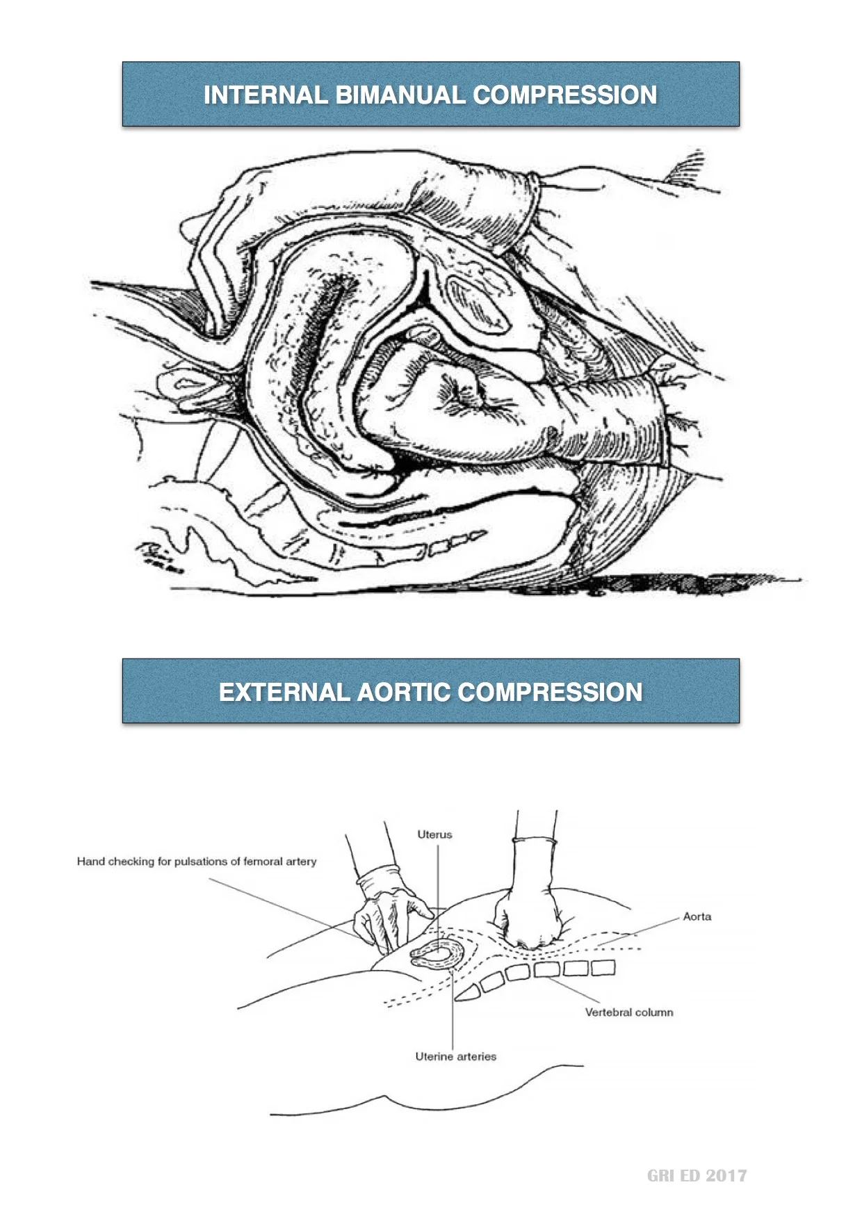 Postpartum Haemorrhage JPEG 2.jpg