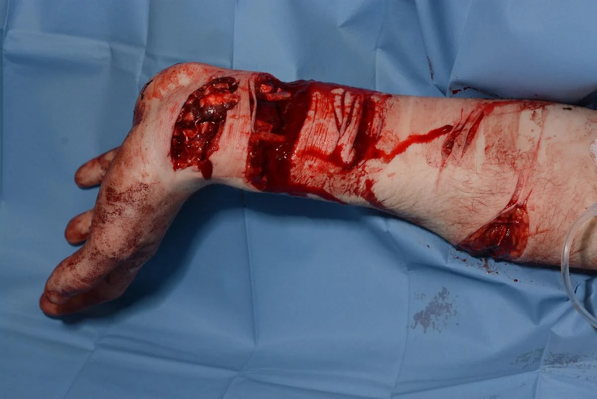 Wrist wounds.jpg