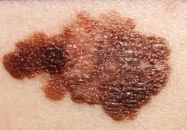 Malignant melanoma.jpg