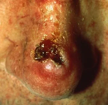 Squamous cell carcinoma.jpg