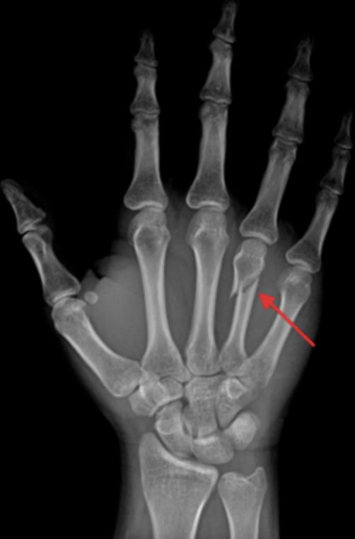 metacarpal fracture.png