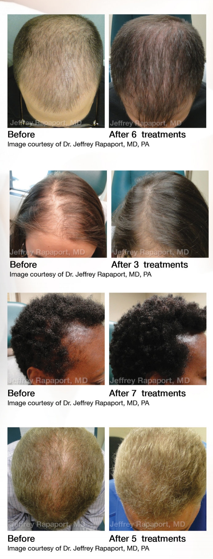 Prp Treatments Needed For Hair | Beverly Hills Hair Restoration