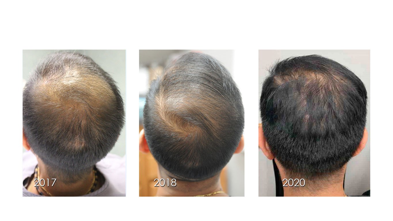 JCM | Free Full-Text | Autologous Platelet-Rich Plasma (PRP) for Treating  Androgenetic Alopecia: A Novel Treatment Protocol Standardized on 2 Cases
