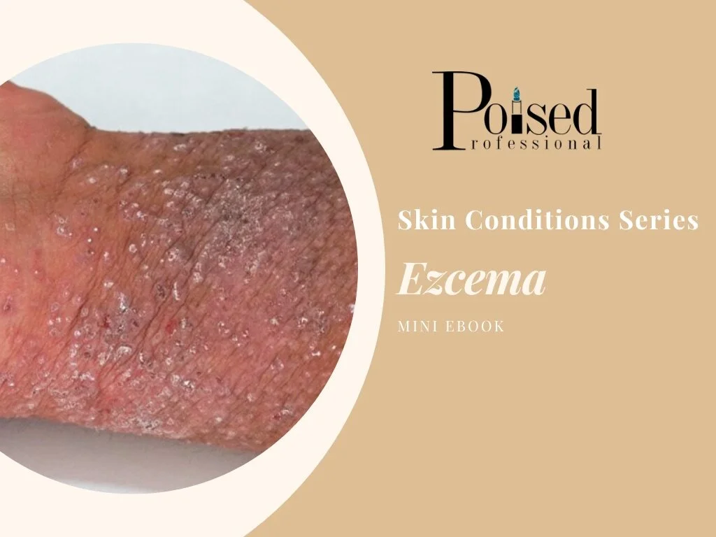 Eczema Webinar