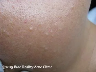 Acne 101