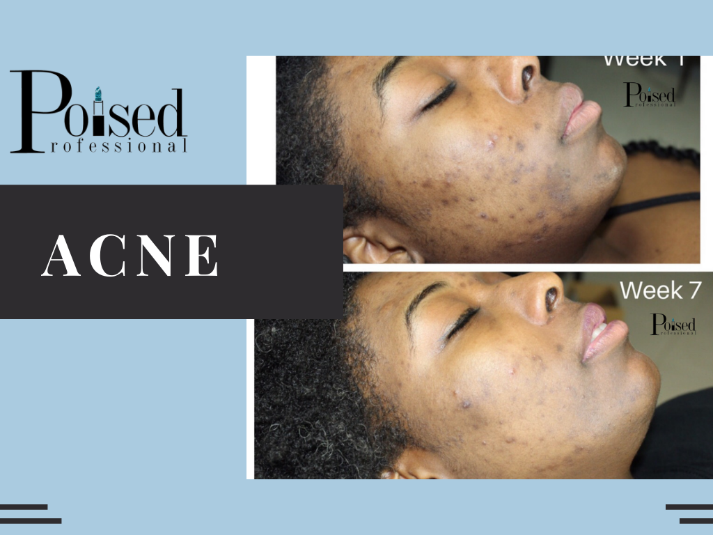 What is Acne eBook?
