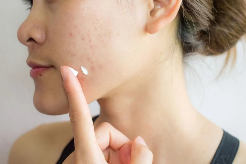 Is Benzoyl Peroxide Safe?