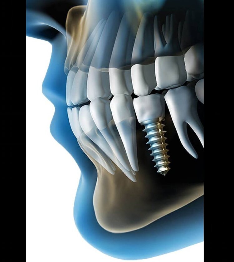 img3 implants.jpg