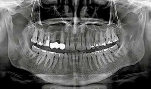 Picture of dental X-ray for accurate assessment