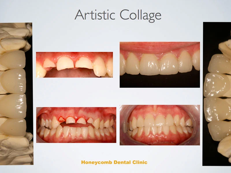 e.max-Anterior-Crowns.jpg