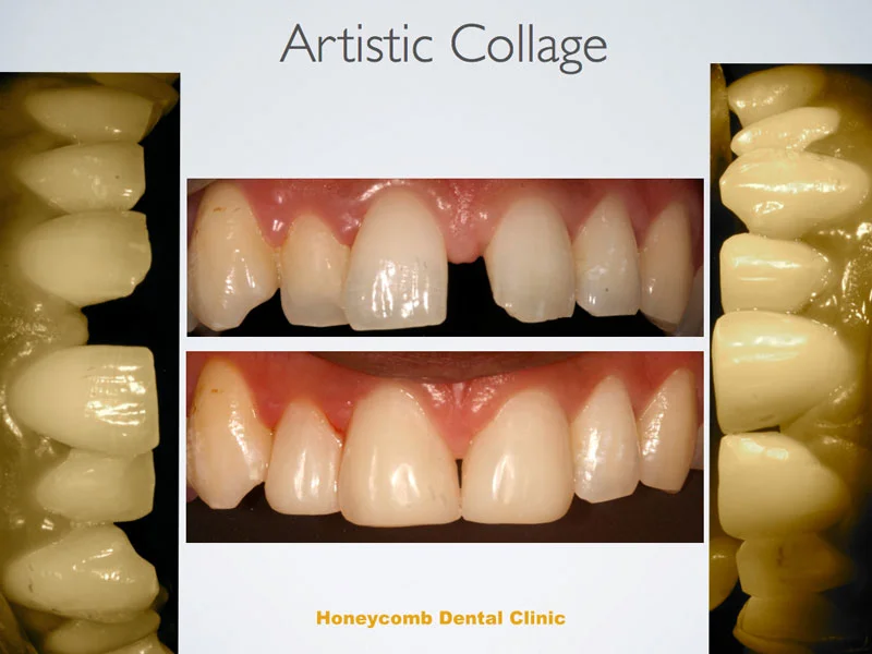 composite-build-up-case-GAP.jpg