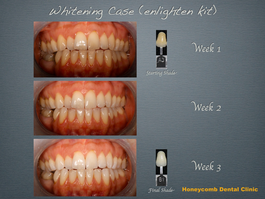 Smile gallery Family Dentist in Somerset Dental Clinic