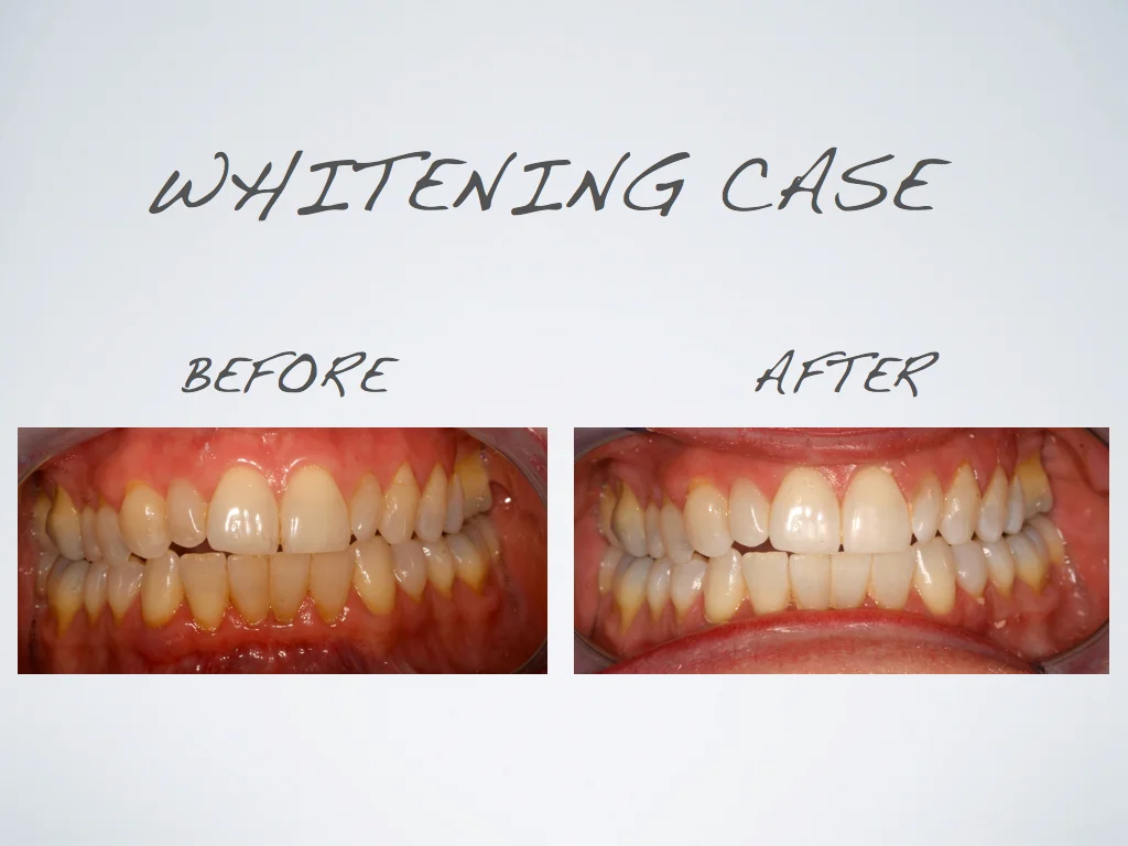 whitening_case_1.jpg