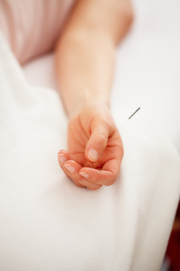Acupuncture for Pain St. Petersburg, FL Art of Acupuncture