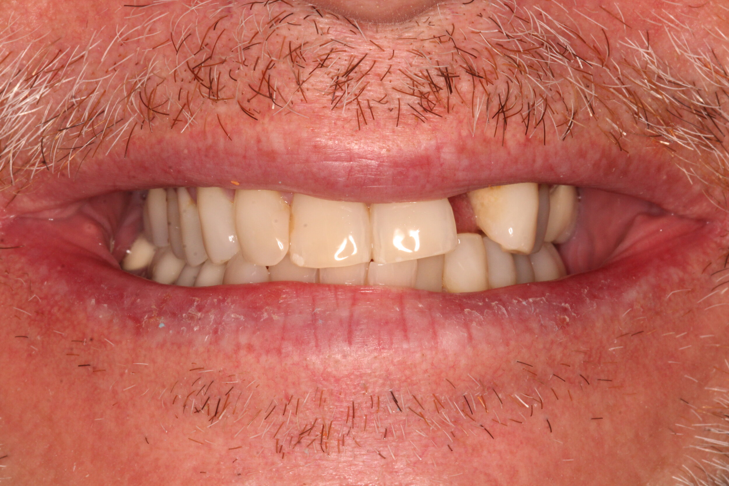  Case 1 - Natural smile with anterior tooth missing. Before placement of zirconia implant. 