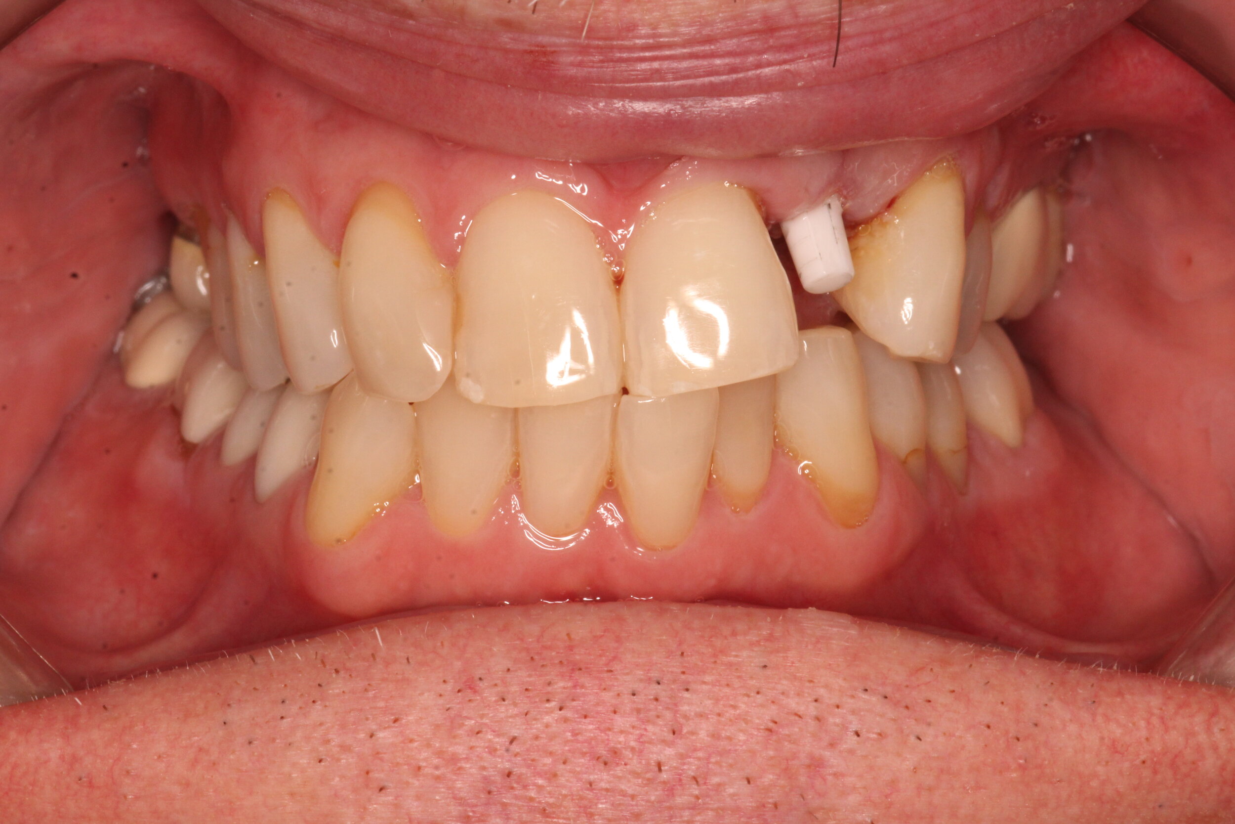  Case 1 - Retracted smile after anterior zirconia implant, healed and ready for crown preparations. 