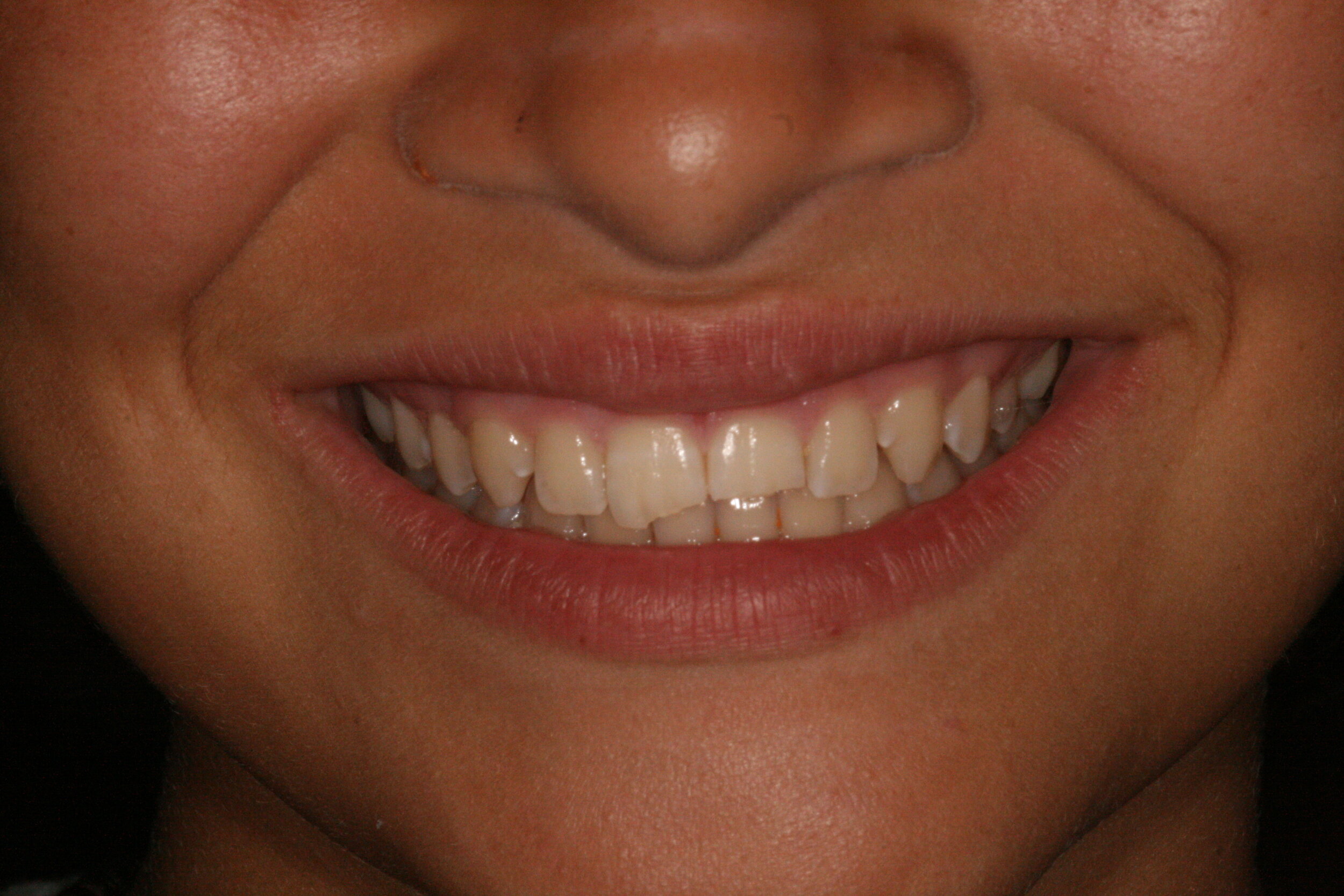  Before Repair  Because the patient’s cracked teeth were too close to the nerve, the treatment would have been to perform a root canal on both top front teeth. However, Dr. Cortés was able to save the teeth and repair them with “reverse veneers”.  